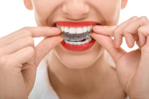 Inserting Invisalign clear braces on teeth