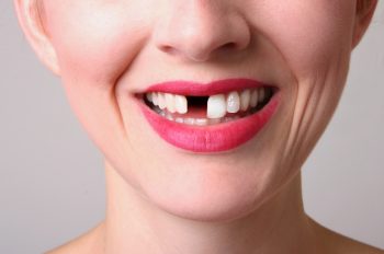 Fort Worth, TX dentist, Dr. Green at Fort Worth Cosmetic & Family Dentistry, talks about missing teeth – why you should replace them and the best ways to do so.